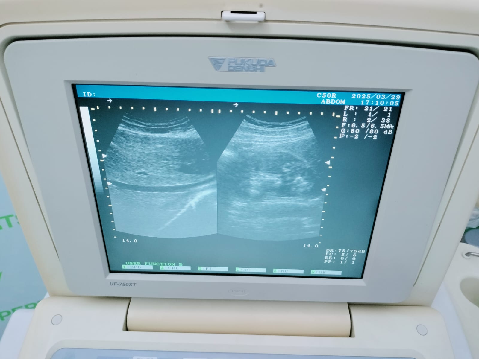 Portable Color Doppler with Convex Probe Only & Printer Trolley